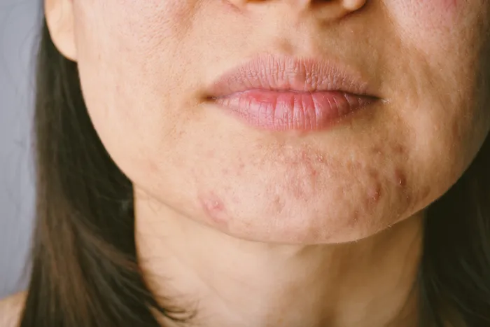 Understanding Acne Medication: A Comprehensive Guide